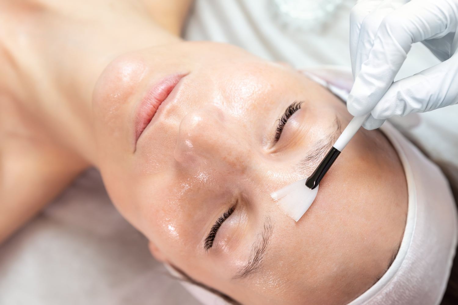 Glycolic Acid Chemical Peel